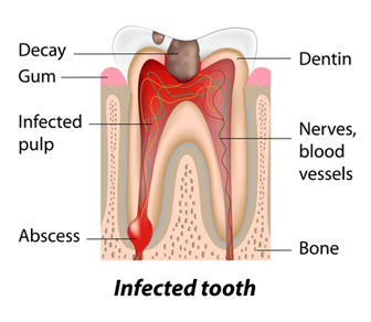 root_canal