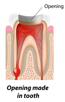 root_canal_to_save_my_tooth