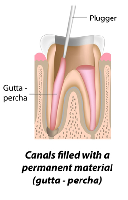 root_canal_to_save_my_tooth_2