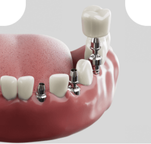  Dental Implant Rowtree Dental Care