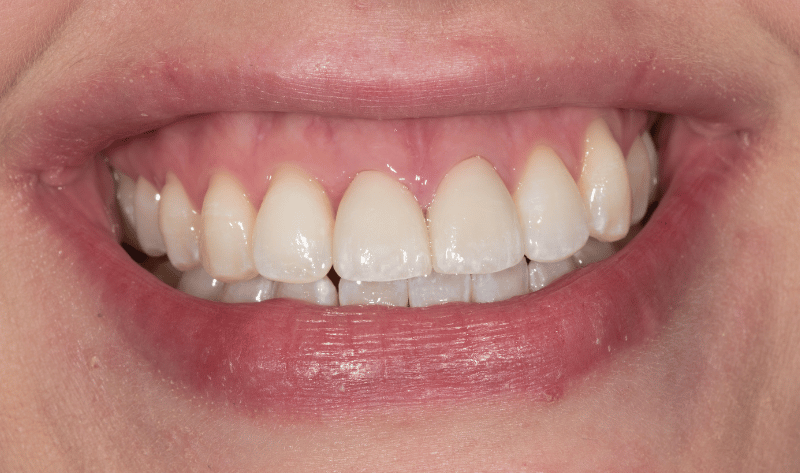 After - Rowtree Dental Care