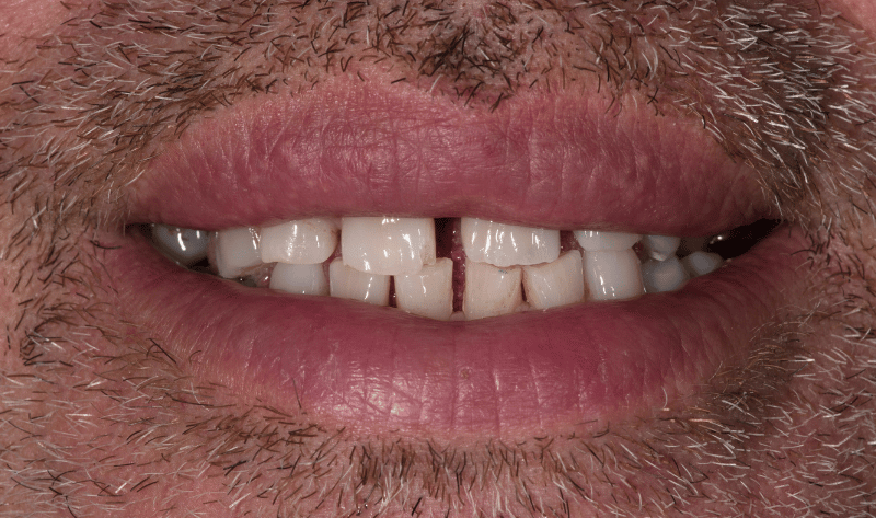 After - Rowtree Dental Care