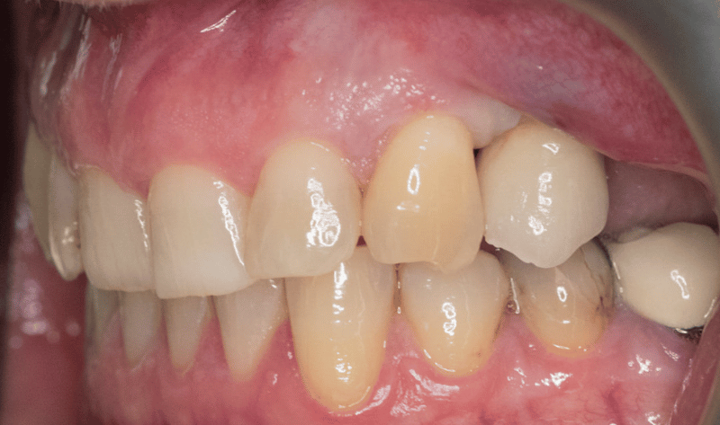 After - Rowtree Dental Care