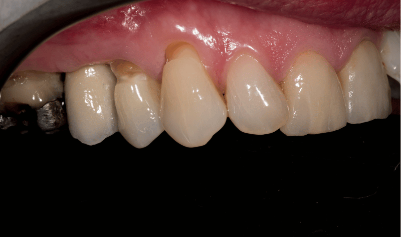 After - Rowtree Dental Care