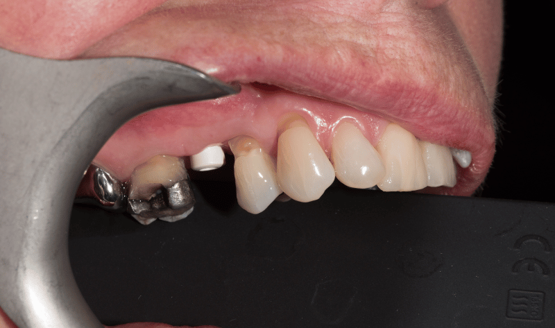 Before - Rowtree Dental Care