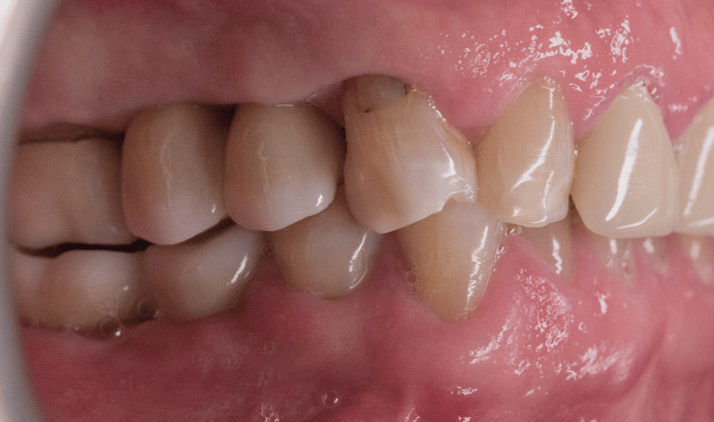 After - Rowtree Dental Care