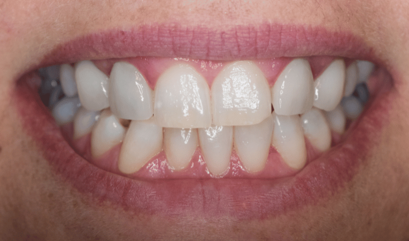 After - Rowtree Dental Care