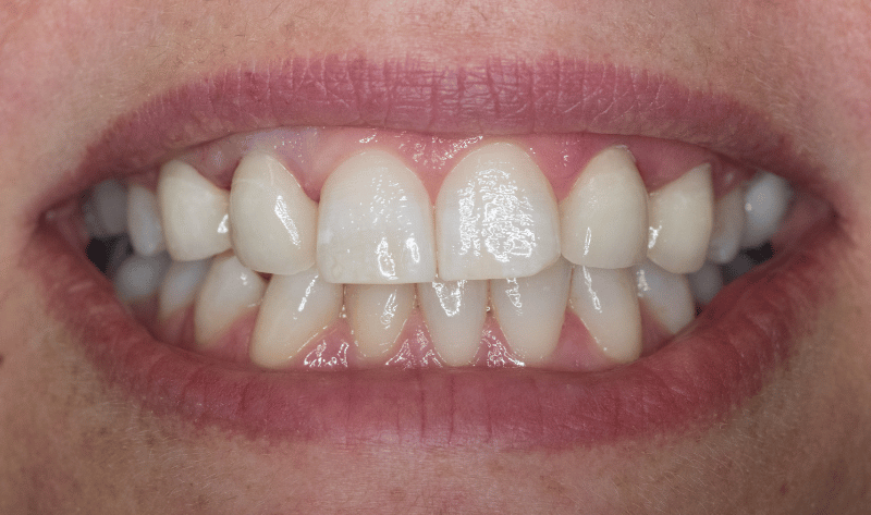 Before - Rowtree Dental Care