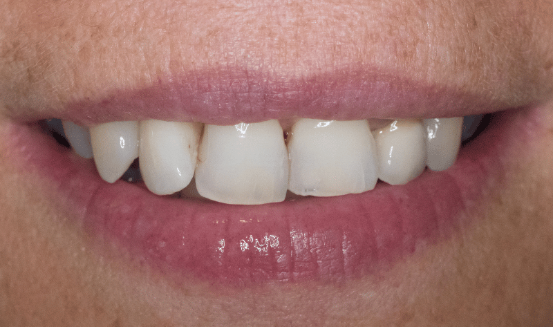 After - Rowtree Dental Care