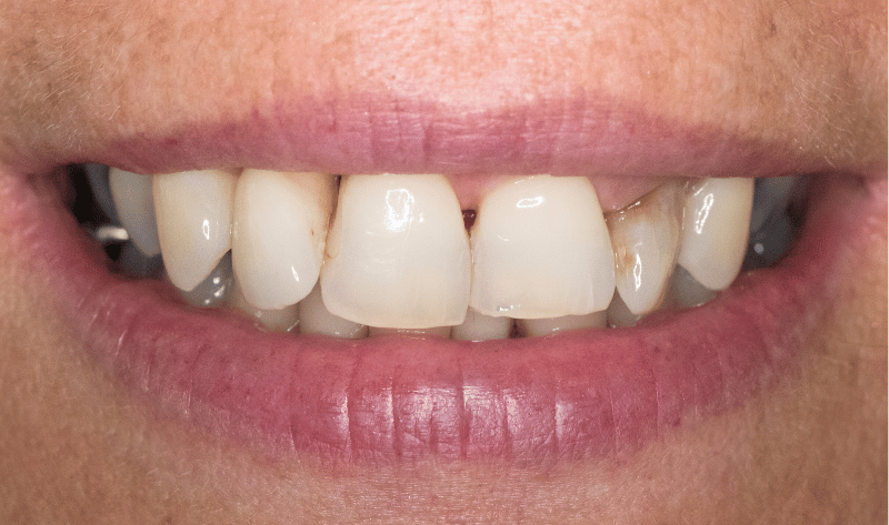 Before - Rowtree Dental Care