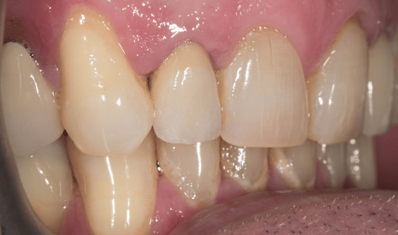 After - Rowtree Dental Care