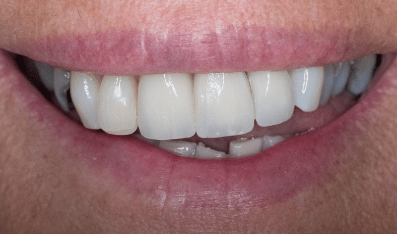 After - Rowtree Dental Care