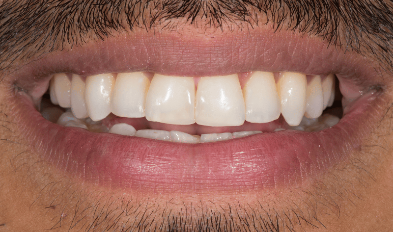 After - Rowtree Dental Care
