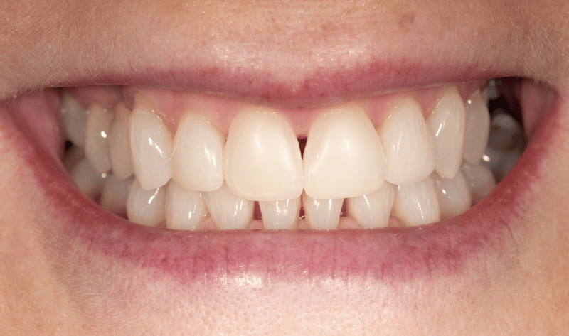 After - Rowtree Dental Care